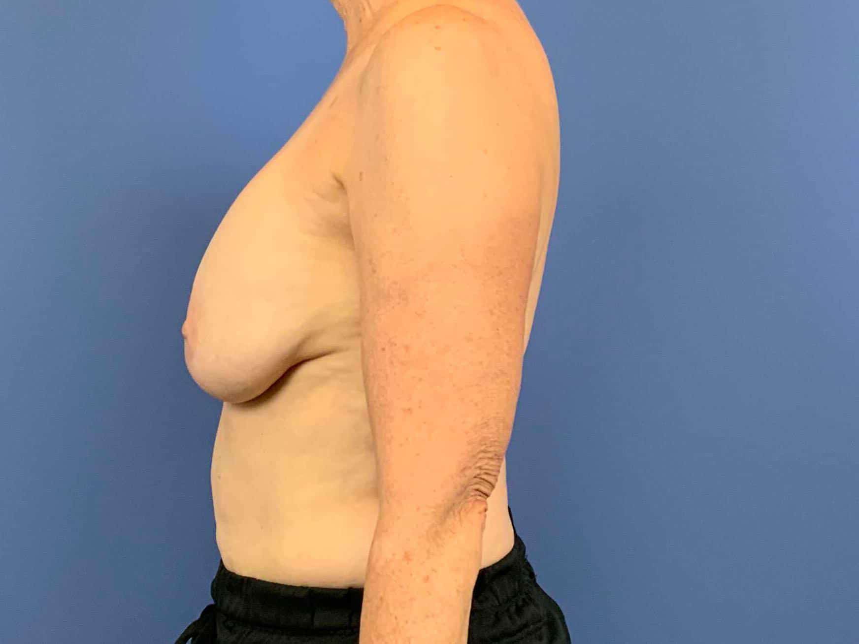Breast Implant Removal before photo