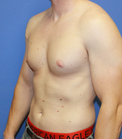 Gynecomastia result at Dr. York Yates Plastic Surgery