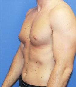Gynecomastia before photo