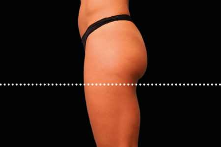 Emsculpt result at Dr. York Yates Plastic Surgery