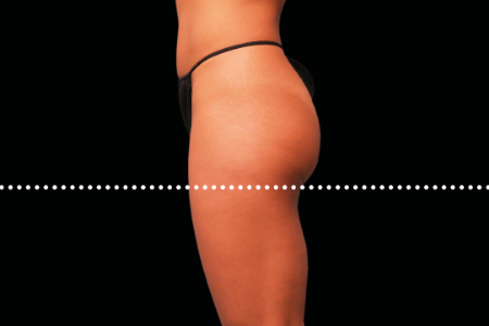 Emsculpt before photo