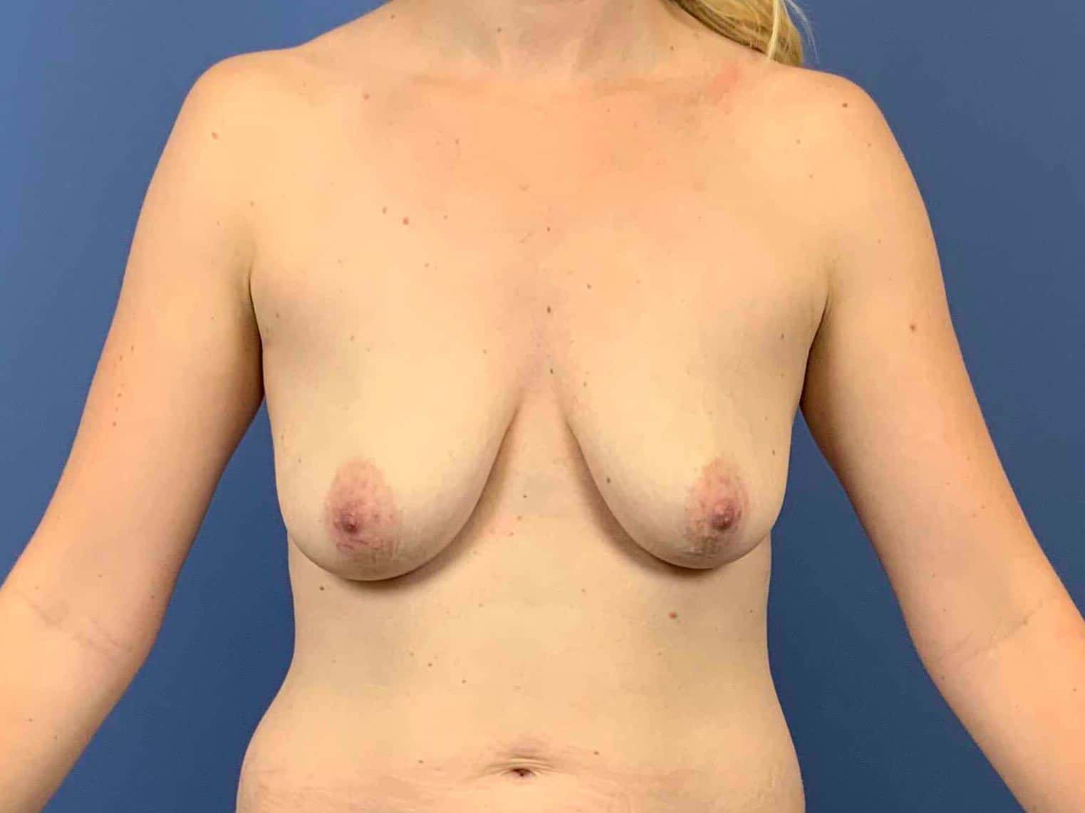 Breast Fat Transfer before photo