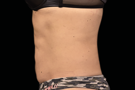 Dr. York Yates Plastic Surgery emsculpt after — Tanner Clinic -Layton Parkway, UT