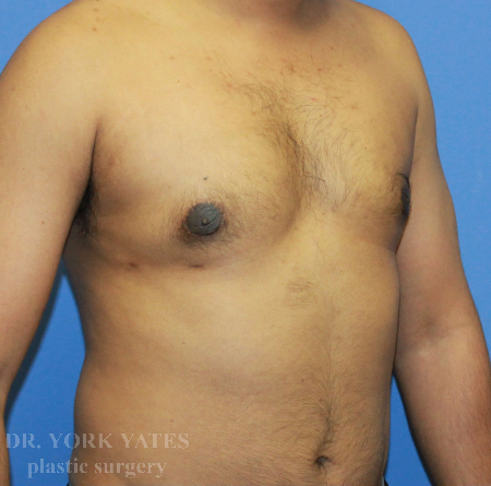 Gynecomastia result at Dr. York Yates Plastic Surgery