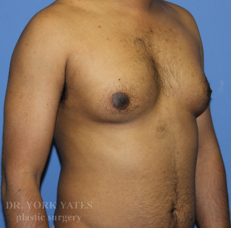 Gynecomastia before photo