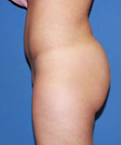 Dr. York Yates Plastic Surgery bbl after — Tanner Clinic -Layton Parkway, UT