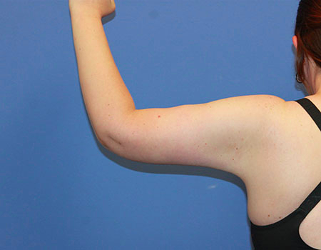 Arm Lift result at Dr. York Yates Plastic Surgery