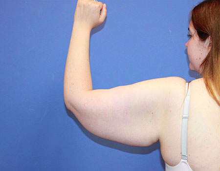 Arm Lift before photo