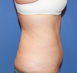 Arm Lift result at Dr. York Yates Plastic Surgery
