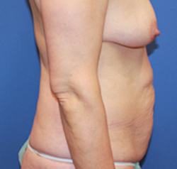 Arm Lift before photo