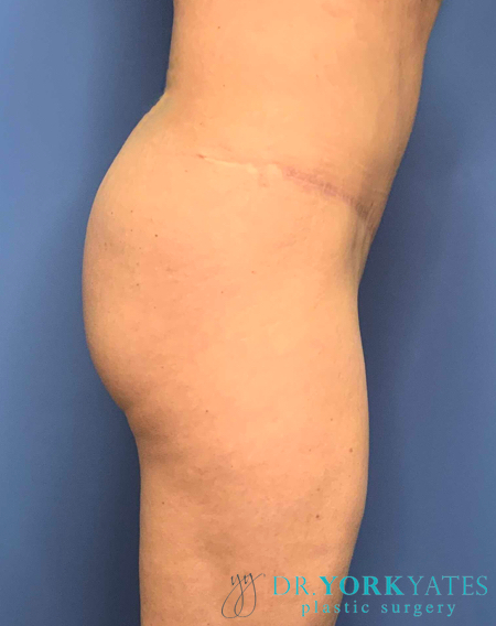 Liposuction result at Dr. York Yates Plastic Surgery
