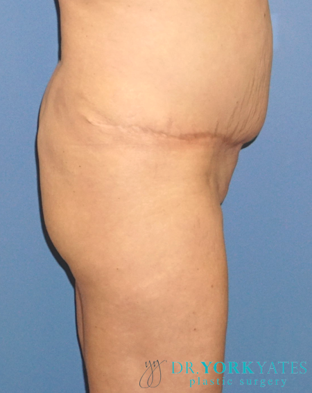 Liposuction before photo