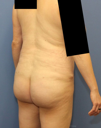 Bbl result at Dr. York Yates Plastic Surgery