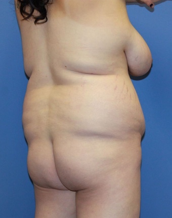 Bbl before photo