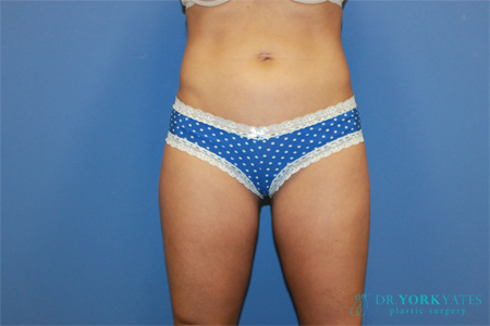 Dr. York Yates Plastic Surgery coolsculpting after — Tanner Clinic -Layton Parkway, UT