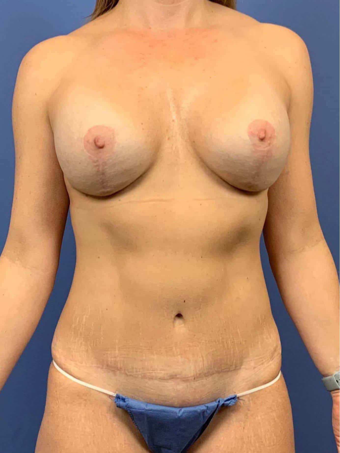 Implant Revision result at Dr. York Yates Plastic Surgery