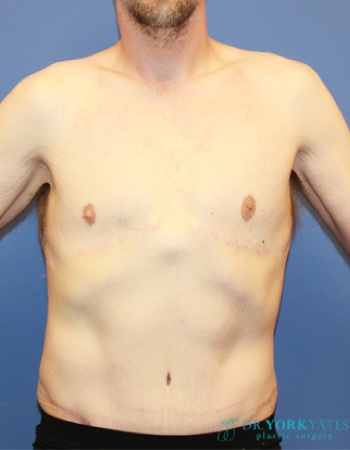 Gynecomastia result at Dr. York Yates Plastic Surgery