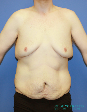 Gynecomastia before photo