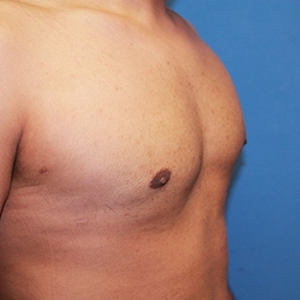Gynecomastia result at Dr. York Yates Plastic Surgery