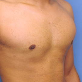 Gynecomastia before photo