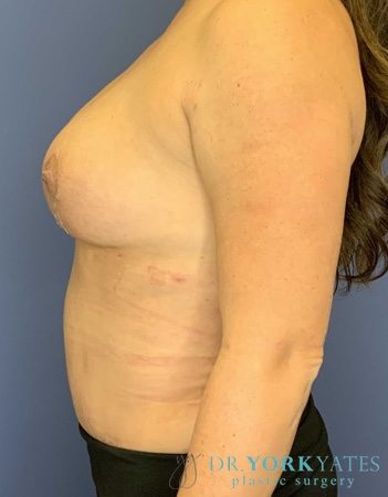 Dr. York Yates Plastic Surgery breast fat transfer after — Tanner Clinic -Layton Parkway, UT