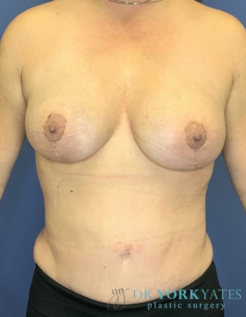 Breast Fat Transfer result at Dr. York Yates Plastic Surgery
