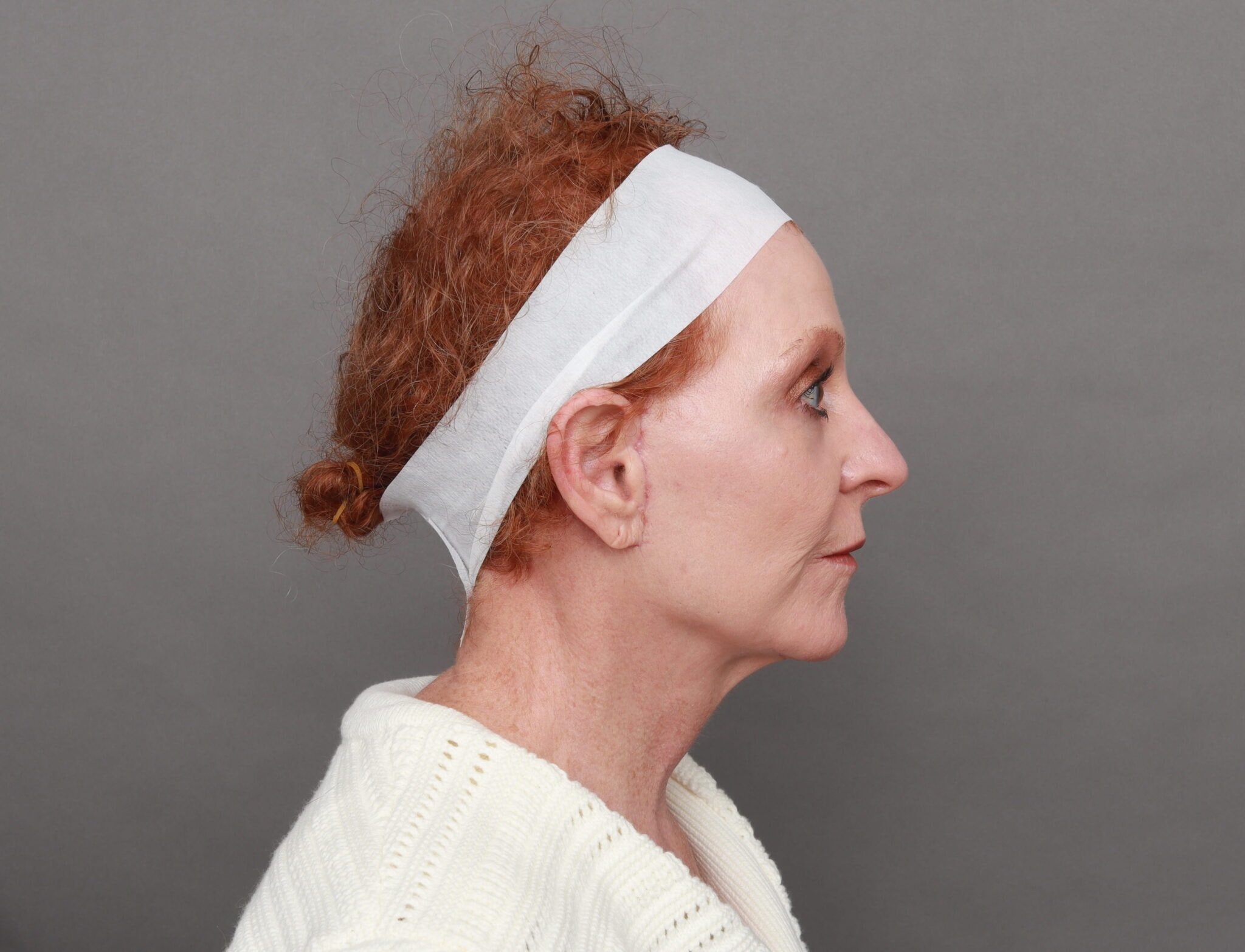 A result from O'Neill Plastic Surgery