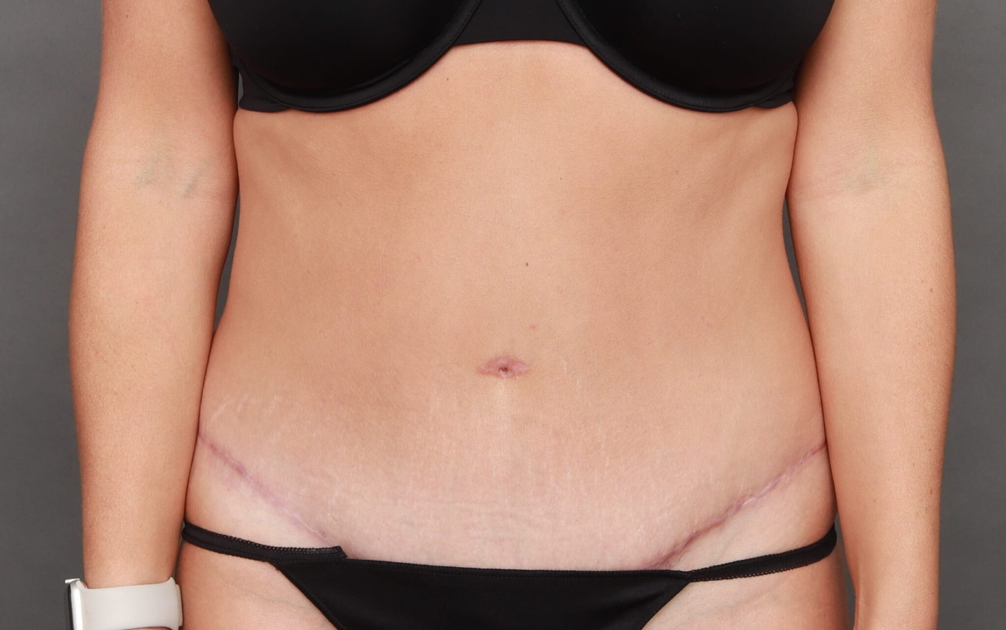A result from O'Neill Plastic Surgery