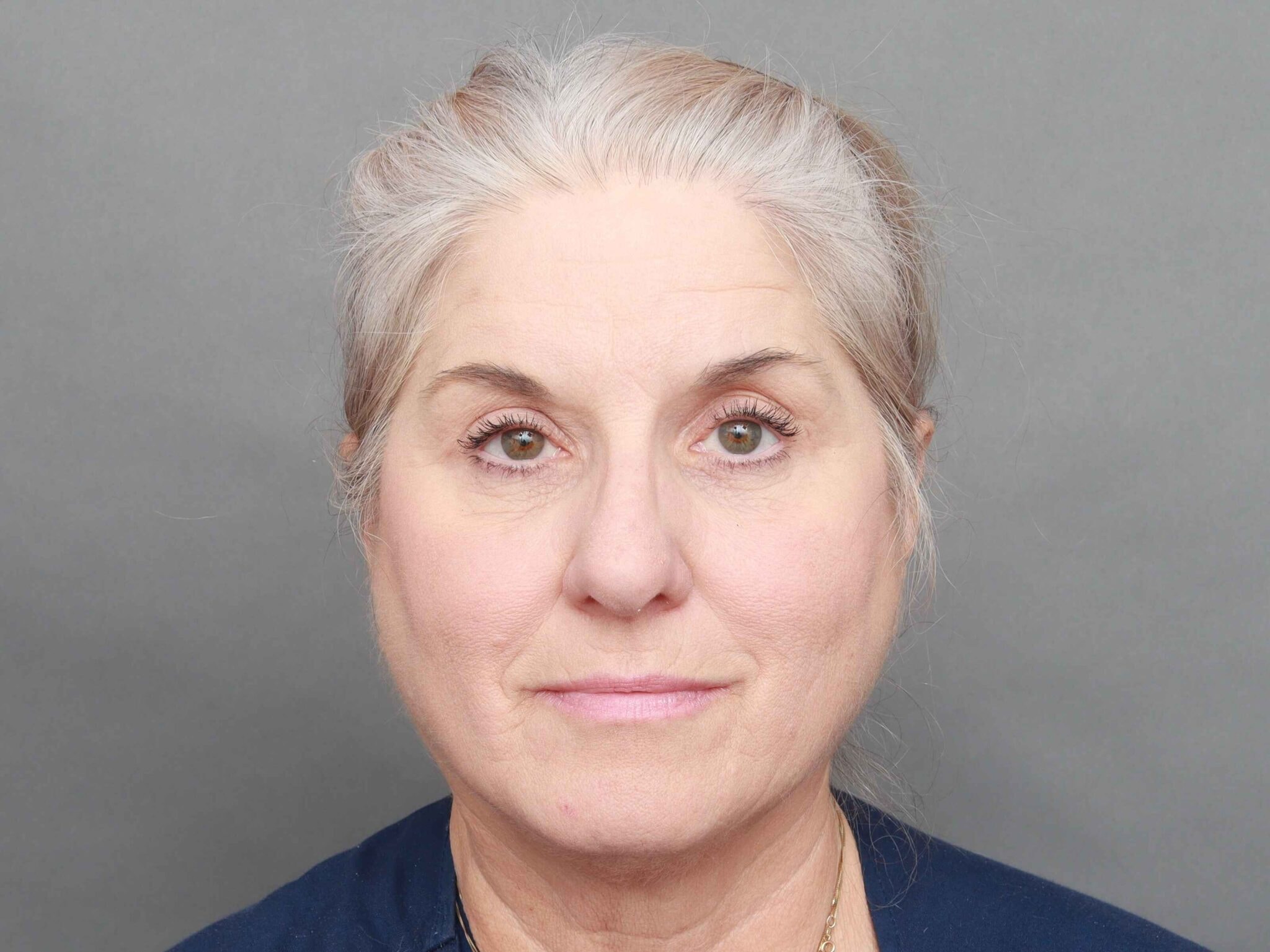 A result from O'Neill Plastic Surgery