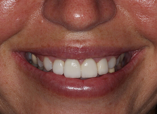 A result from La Jolla Cosmetic Dentistry and Orthodontics