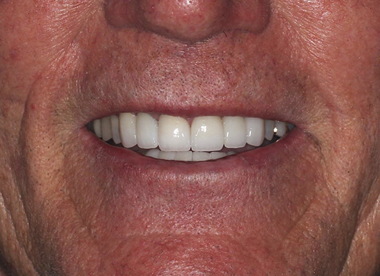 A result from La Jolla Cosmetic Dentistry and Orthodontics