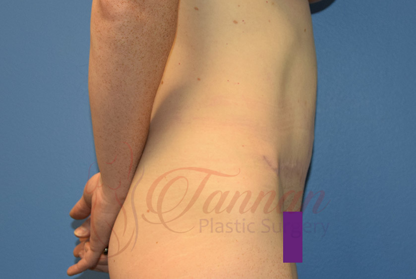 A result from Tannan Plastic Surgery