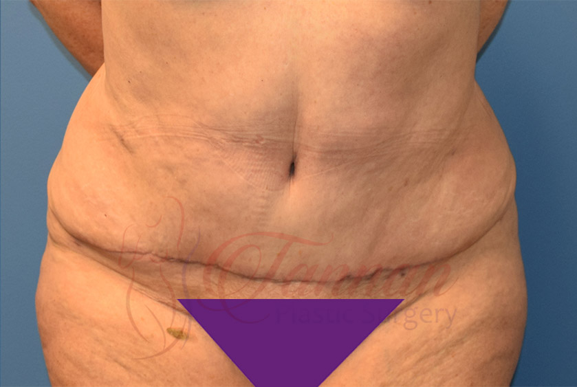 A result from Tannan Plastic Surgery