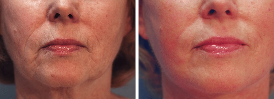 A result from ARTIS Institute - Dr. Sarraga