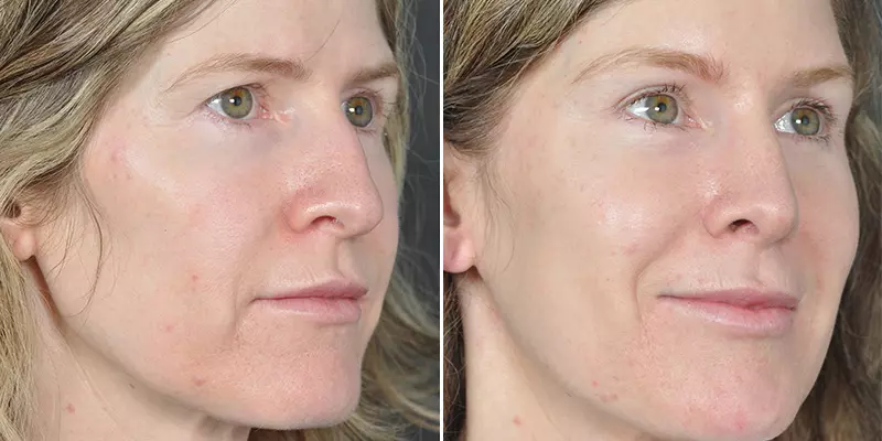 Rhinoplasty result at Kao Plastic Surgery