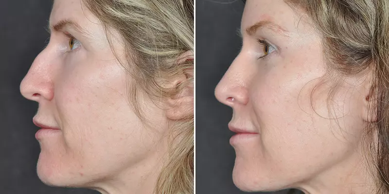 Rhinoplasty result at Kao Plastic Surgery