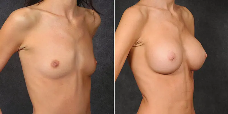 Breast Augmentation result at Kao Plastic Surgery