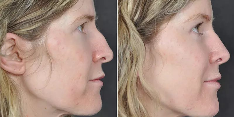 Rhinoplasty result at Kao Plastic Surgery