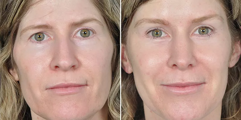 Rhinoplasty result at Kao Plastic Surgery