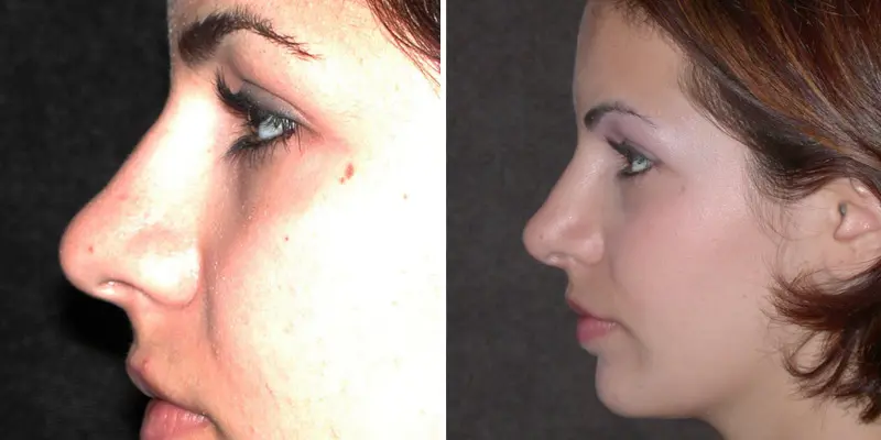 Rhinoplasty result at Kao Plastic Surgery