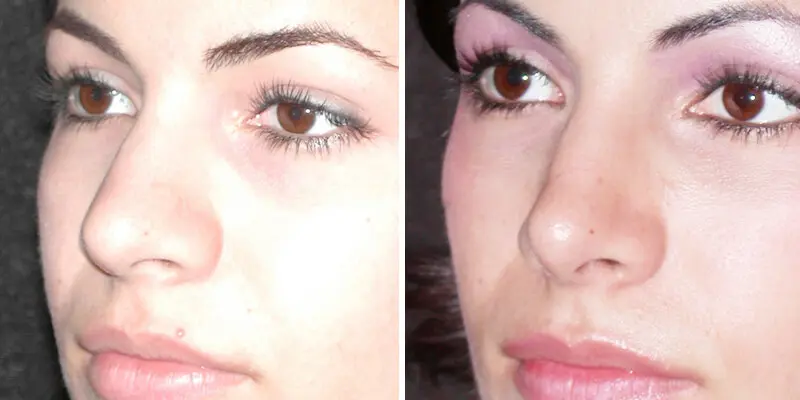 Rhinoplasty result at Kao Plastic Surgery