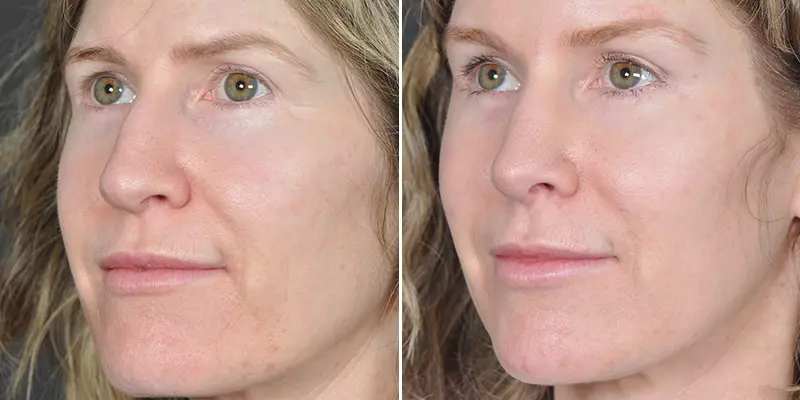 Rhinoplasty result at Kao Plastic Surgery