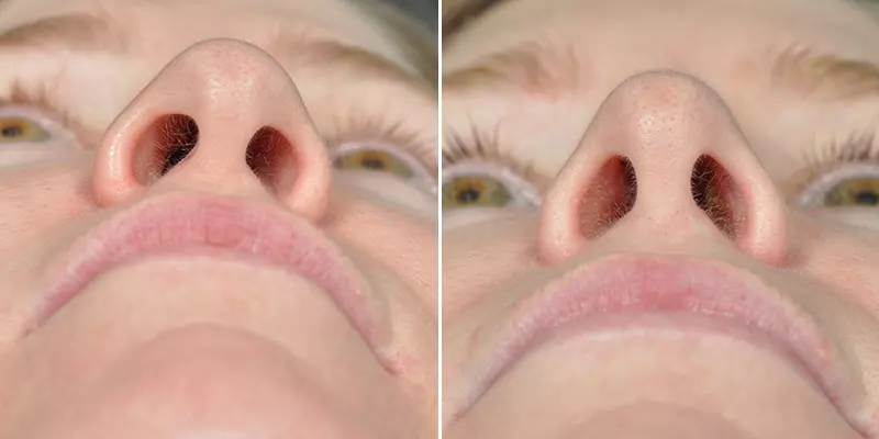 Rhinoplasty result at Kao Plastic Surgery