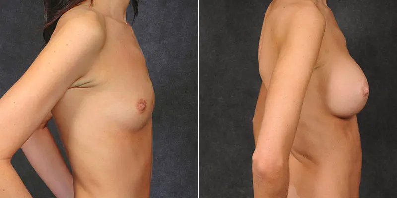 Breast Augmentation result at Kao Plastic Surgery
