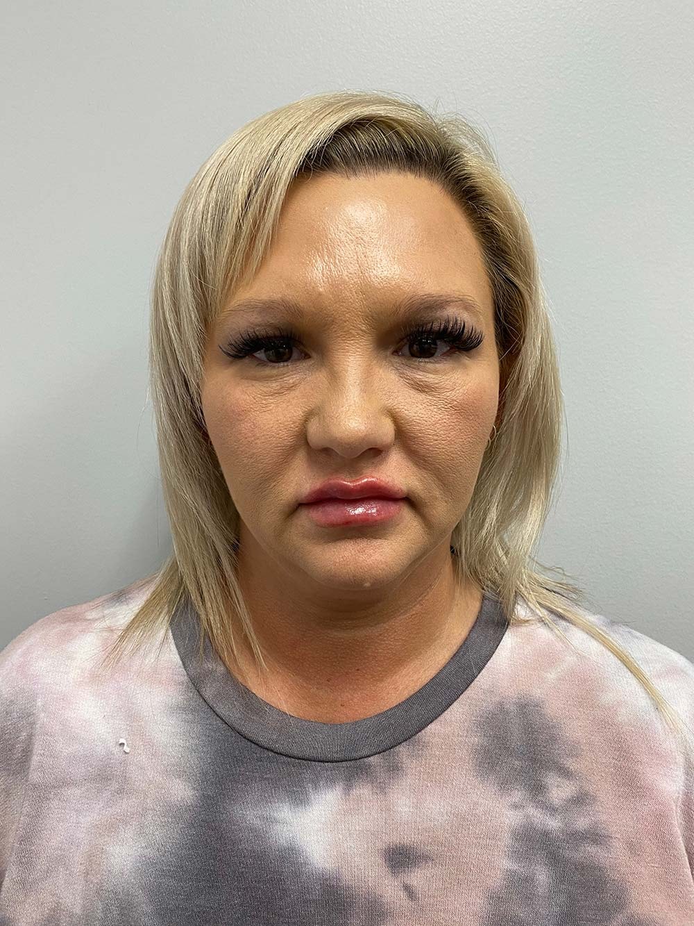 A result from Skin Perfect Medical Aesthetics
