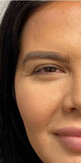 A result from Skin Perfect Medical Aesthetics