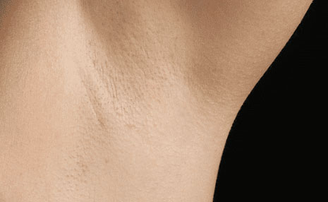 Hair Restoration result at Los Angeles Center For Cosmetic Surgery