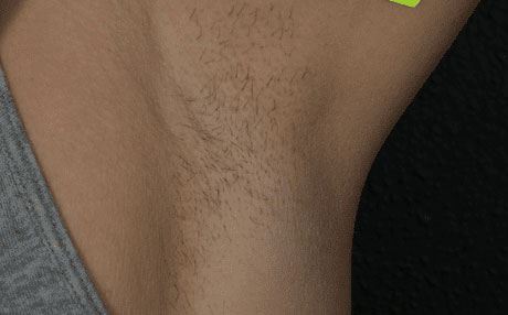 Hair Restoration before photo