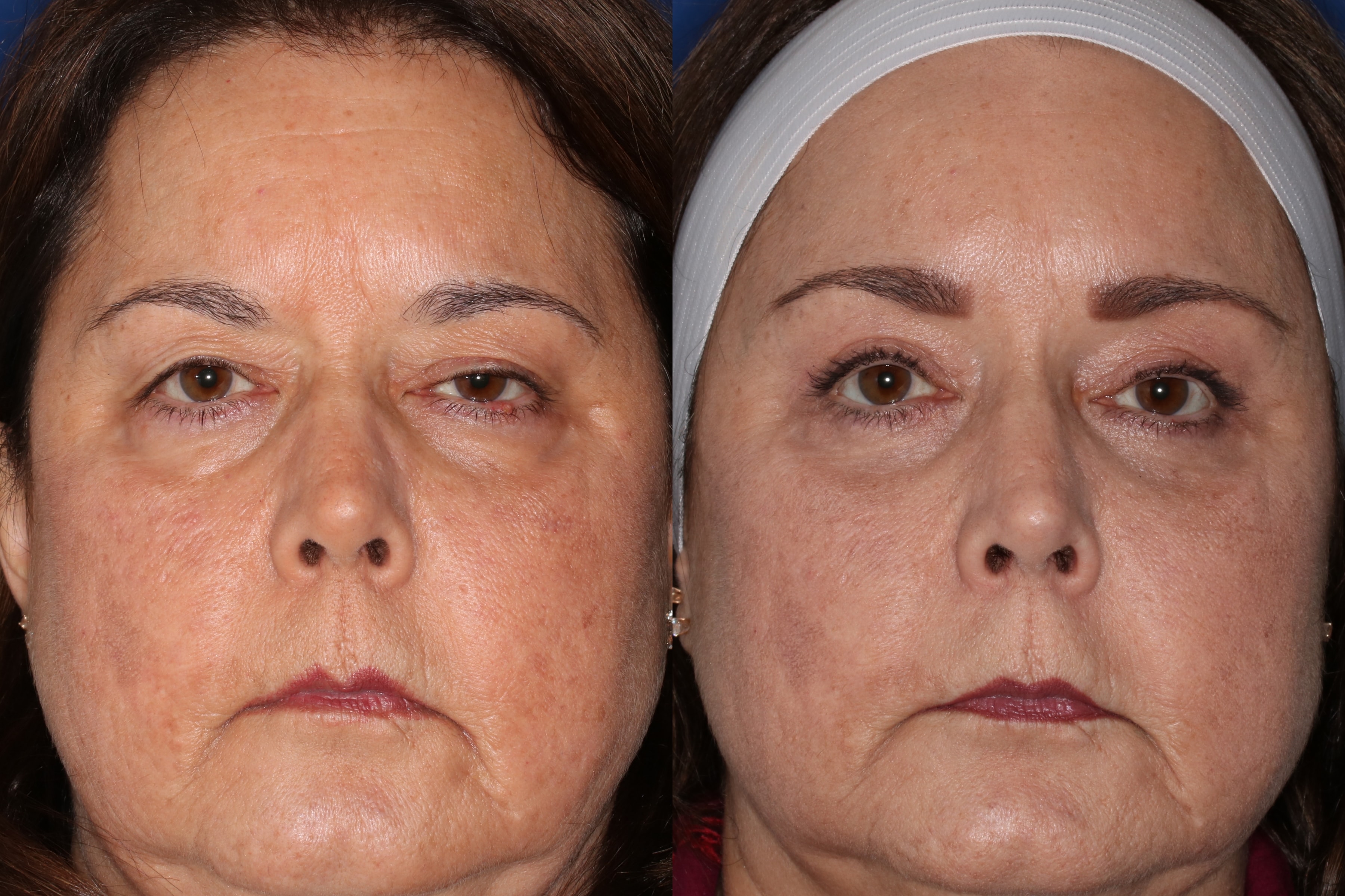 A result from Francisco Castillo, MD
