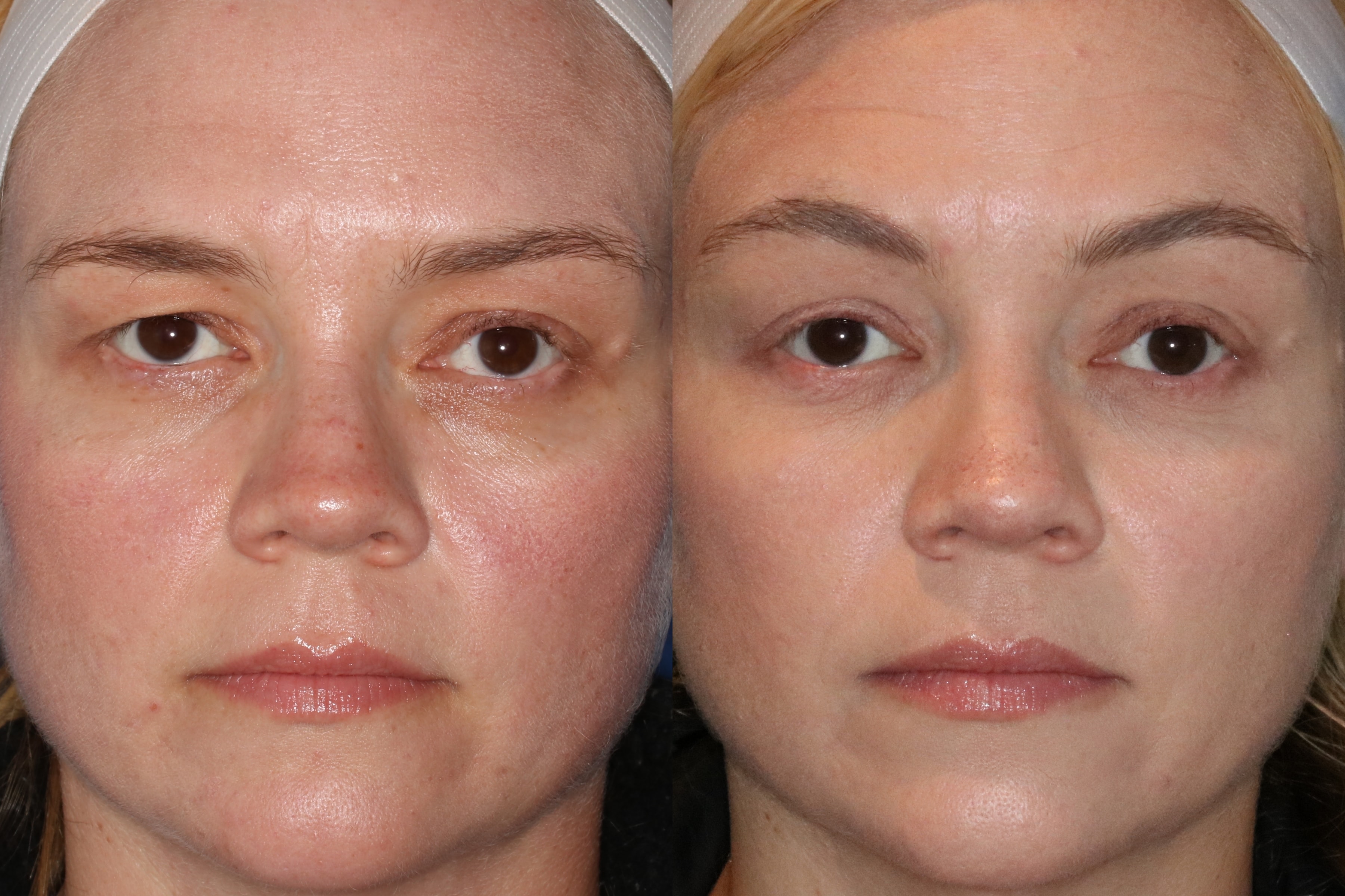 A result from Francisco Castillo, MD